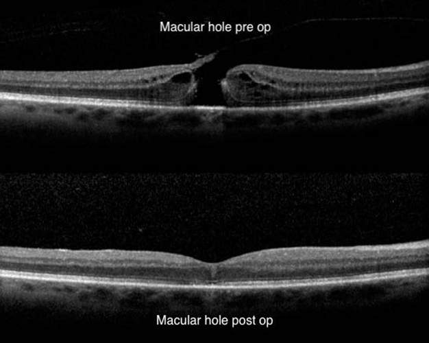 Difference between post of and pre op macular holes 