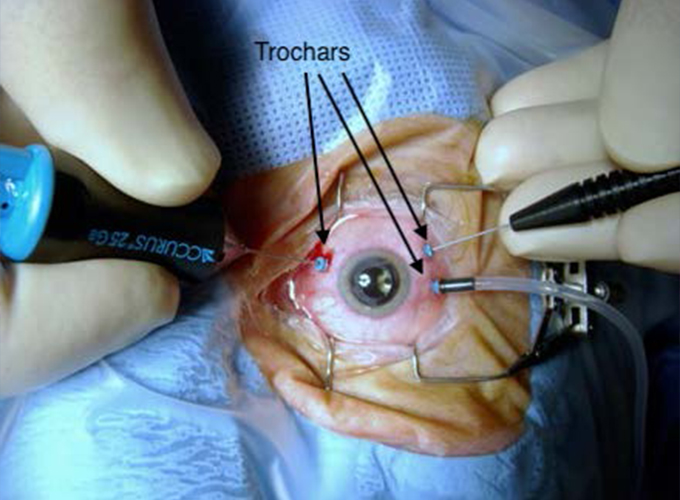 Trochars