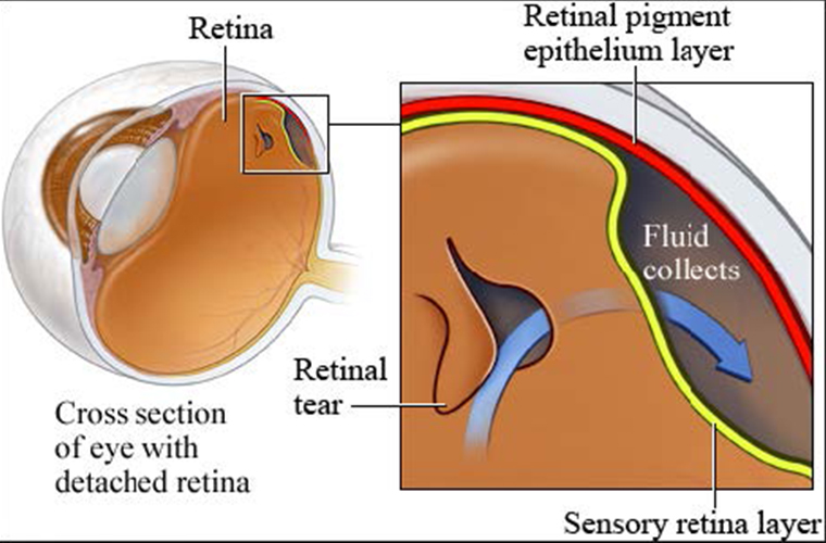 Retinal Detachment 