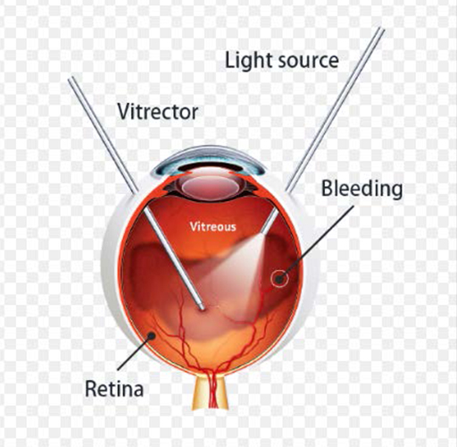 Diabetic Eye Disease With Bleeding 