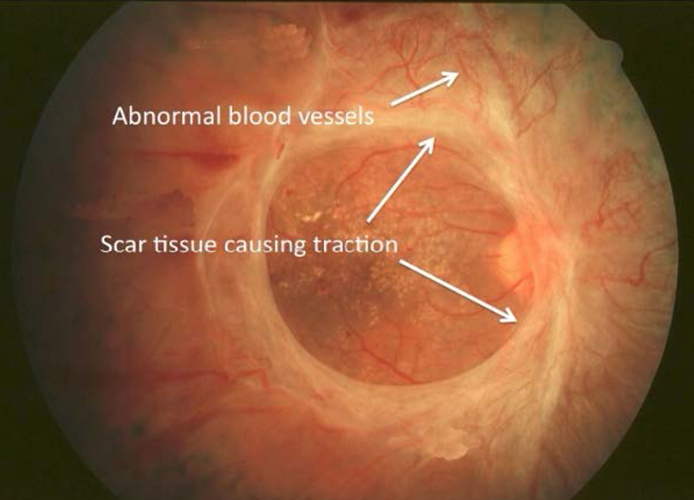 Repairing Retinal Bleeding with a Vitrectomy