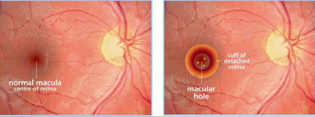 Fixing a Macular Hole with a Vitrectomy